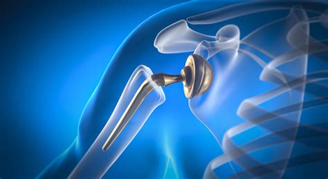 Anatomic vs. Reverse Shoulder Arthroplasty: Which Shoulder Replacement Is Right for You? | Texas ...