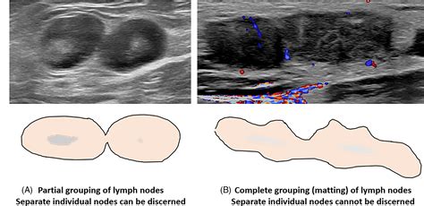 Groin Lymph Nodes Ultrasound