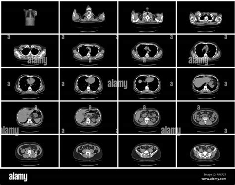 Ct scan abdomen hi-res stock photography and images - Alamy