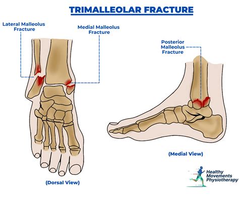 Foot & Ankle Injuries - Healthy Movements Physiotherapy