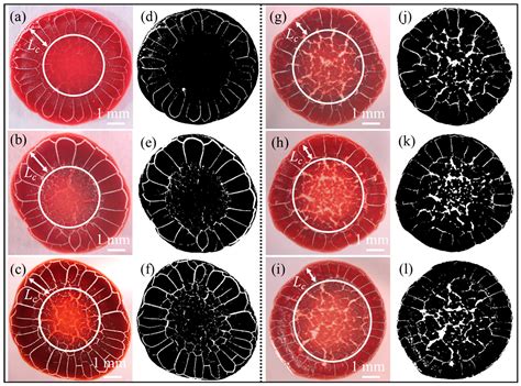 A Point-of-Care Diagnostic Method Using Desiccation Patterns of Blood ...