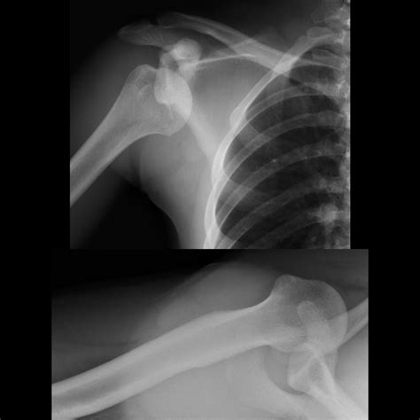 Pediatric Anterior Shoulder Dislocation | Pediatric Radiology Reference Article | Pediatric ...