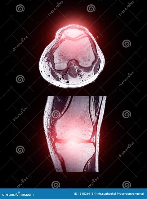 MRI Knee Joint or Magnetic Resonance Imaging . Stock Image - Image of ligaments, cartilage ...
