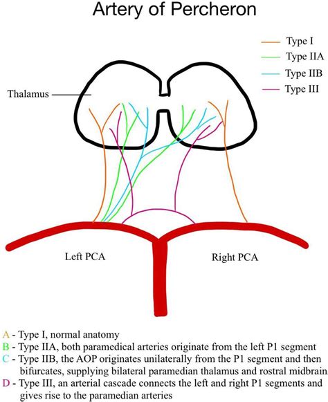 Bilateral thalamic infarction caused by artery of Percheron obstruction | BMJ Case Reports