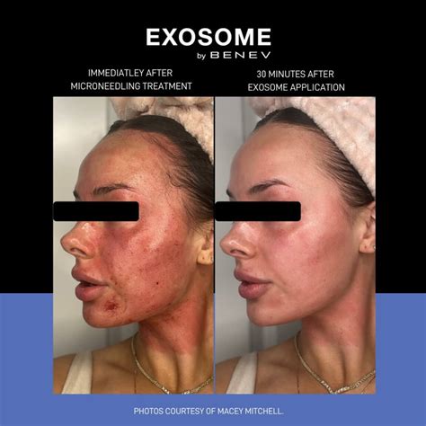 Exosome Therapy - Fruition Skin Therapy