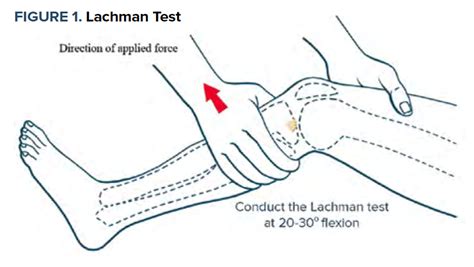Image result for Lachman Testing