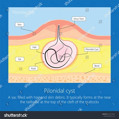 Nest Of Hair Cyst
