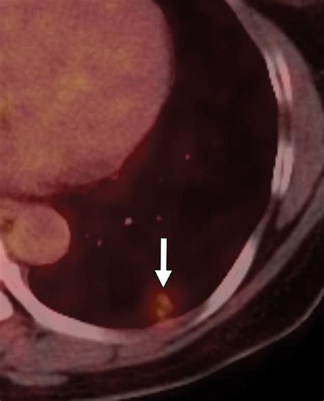Ground-Glass Nodules on Chest CT as Imaging Biomarkers in the Management of Lung Adenocarcinoma ...