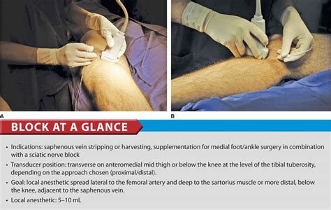 Ultrasound-Guided Saphenous Nerve Block | Anesthesia Key