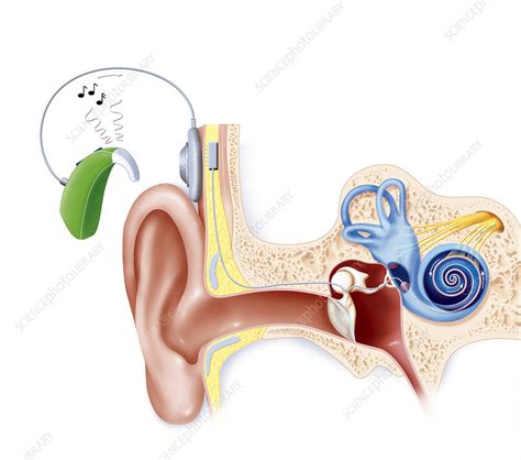Image result for Cochlear
