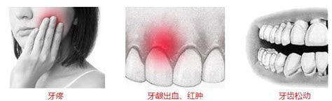 牙龈经常出血是什么原因（牙龈出血怎么办）_牙龈出血-深圳爱康健口腔医院