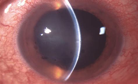 Fuchs corneal endothelial dystrophy