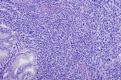 DLBCL: Diffuse Large B-Cell Lymphoma - Cancer Therapy Advisor