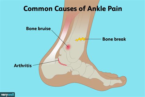 Everything You Need to Know About Ankle Pain