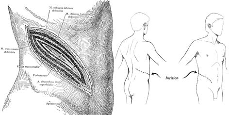 Image result for Flank Incision Nephrectomy