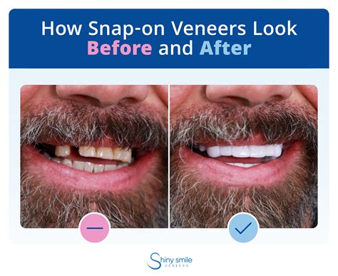 What Are Veneers - Temporary Vs. Permanent Veneers