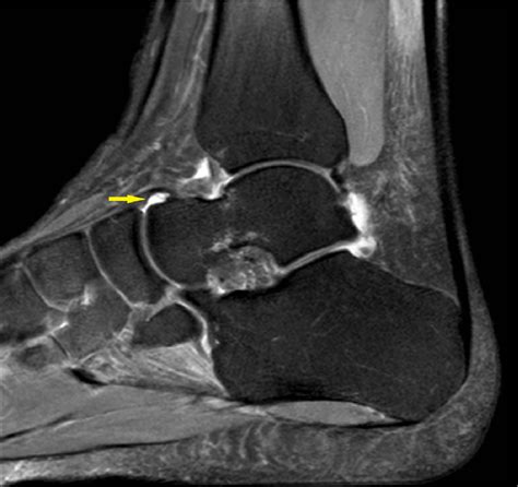 What Is A Joint Effusion Foot at Daniel Pinto blog