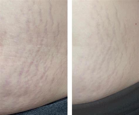 Skinly Aesthetics - Stretch Marks Treatments Explained