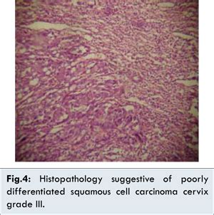 Management of Acute Non-puerperal Complete Uterine Inversion
