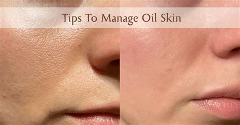 11 Effective Tips To Manage Oily Skin – AreoVeda