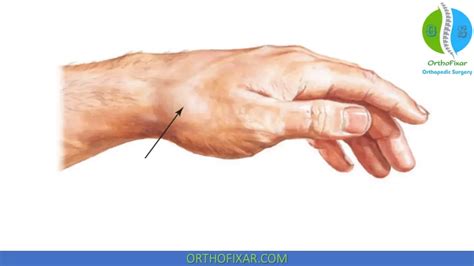 Scaphoid Fracture Test 的图像结果