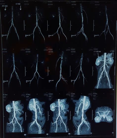 Image result for Distal Loopogram