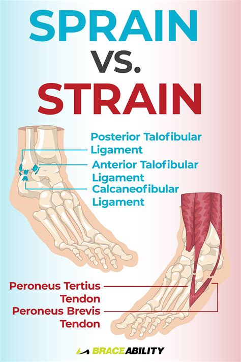 Are you wondering what the difference between a "sprain" and a "strain ...