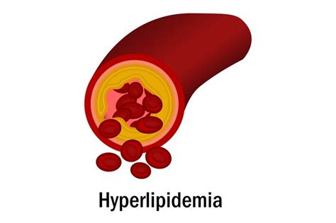 Premium Photo | Hyperlipidemia with blood vessel isolated