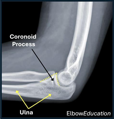 Coronoid Fractures of the Elbow - Elbow Education