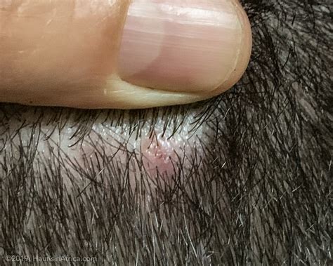 Basal Cell Carcinoma Scalp