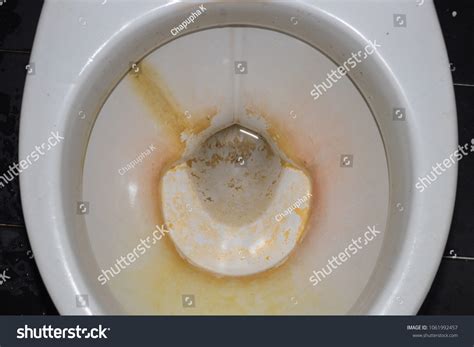 Kidney Stones In Toilet