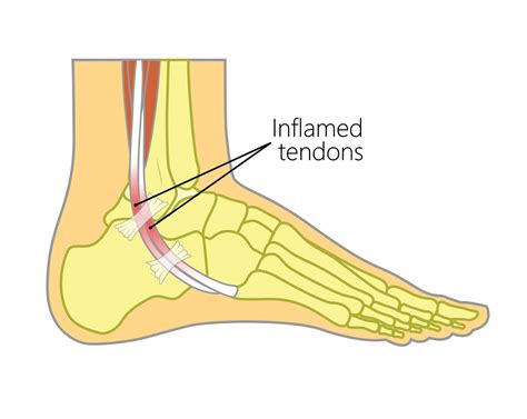 Peroneal Tendonitis Exercises