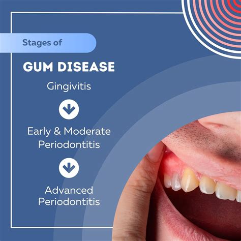 Moderate Gingivitis Gum Disease Symptoms, Stages, Causes, Treatment