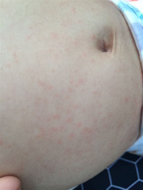 Why Does My Baby Have Little Red Dots On Her Body - Infoupdate.org