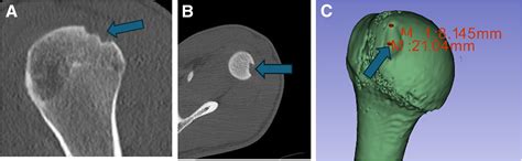 Arthroscopic Humeral Head Hill-Sachs Grafting With Talus Allograft - Arthroscopy Techniques