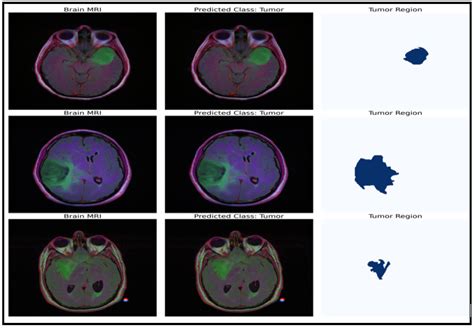 Brain Tumor Detection and Classification Using Fine-Tuned CNN with ...