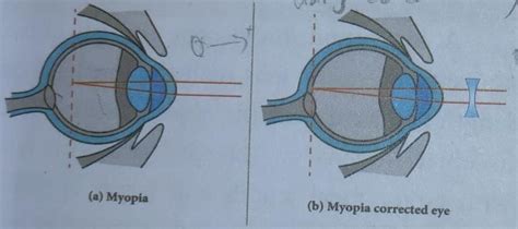 Draw ray diagrams each showing (i) myopic eye and (ii) hypermetropic ...