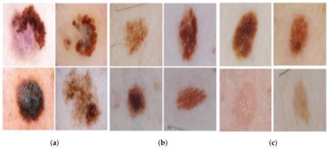 Machine Learning and Deep Learning Methods for Skin Lesion ...