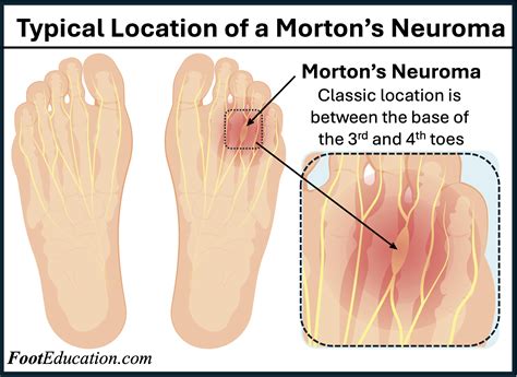 Morton's Neuroma - FootEducation