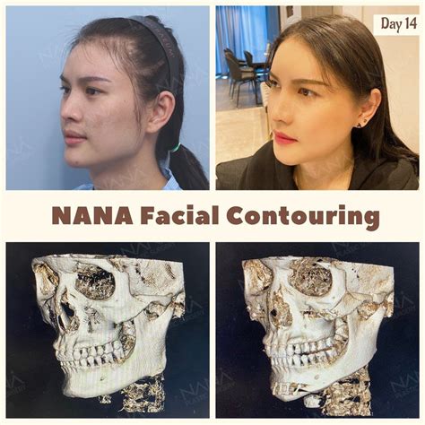 Korean Plastic Surgery Facial Contouring Expert at NANA Plastic Surgery