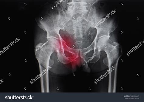 Pelvis X-ray Patient Showing Superior Inferior Stock Photo 1441932803 | Shutterstock