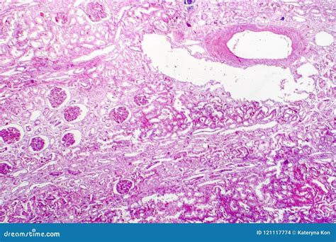 Edema of Renal Tubular Epithelial Cells in Kidney Failure Stock Photo ...