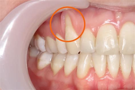 Tooth Recession 的图像结果