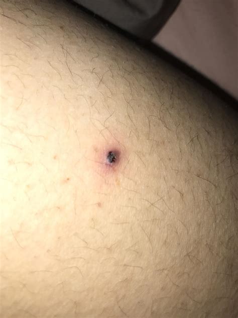 'Pimple' on leg turned black – Back/Body/Neck acne – Acne.org Forum