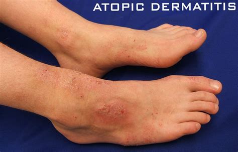 Maltreatment during childhood not linked to adult atopic dermatitis