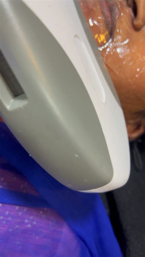 Abhilasha | Korean skin Treatment. * Melasma Treatment * Hyper pigmentation * Acne marks * Dark ...