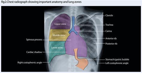 Chest Xray Anatomy