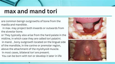 Tori palatinus , tori madibularis and treatment | PPTX