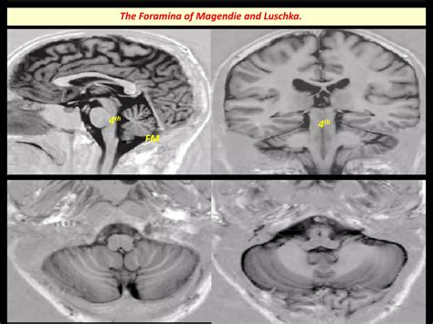 Presentation1.pptx, radiological anatomy of the brain and pituitary gland | PPTX