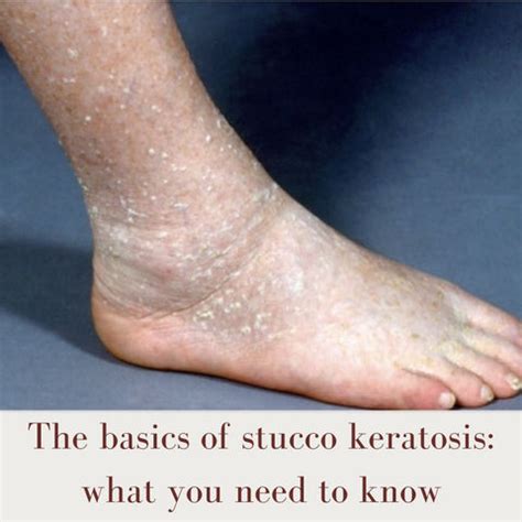 Stucco keratosis uncovered: understanding and managing this common skin ...